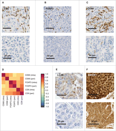 Figure 1. Representative immunohistochemical staining patterns. Breast cancer specimen were stained for the detection of CD8+ cytotoxic T lymphocytes (A), FOXP3+ regulatory T cells (B), CD68+ tumor-associated macrophages (C) and representative samples exemplifying distinct levels of infiltration are shown (upper panel: high infiltration, lower panel: low infiltration). The density of the immune infiltrate in the intratumoral and peritumoral area was quantified, and the different values were correlated among each other (D). The color code in (D) indicates the Spearman correlation coefficients. In addition, tissue sections were stained for the detection of LC3B (E) and HMGB1 (F). In each case, 2 representative tumor samples with distinct staining patterns are shown (upper panel: positive tumor, lower panel: negative tumor). Scale bar is indicated for each staining.