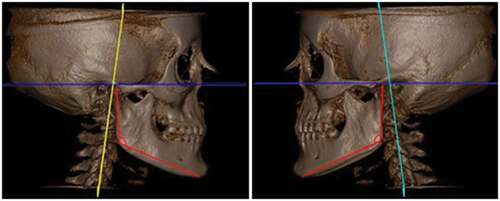 Figure 3. Images and measurements obtained by the SYM 3D protocol evaluating the morphology of the gonial angle.