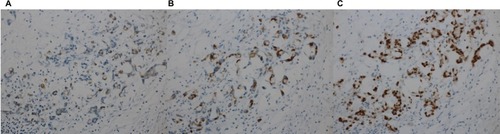 Figure 1 The immunohistochemical stains of peritoneal tumor tissue revealed frequent positive expression of (A) CK20, (B) CDX2, and (C) MUC2. Magnification: 40×.