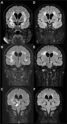 Figure 2 Brain MRI images before and after B-cell depleting therapy.