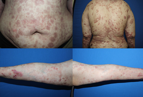 Figure 3 Improvement of BSLE after rituximab therapy. One month after 2 intravenous infusions of rituximab 1000 mg with a 2-week interval apart, most of the lesions healed with post-inflammatory hyperpigmentation.