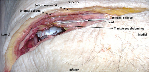 Figure 5 Cadaveric dissection revealing lead location after percutaneous lead place.