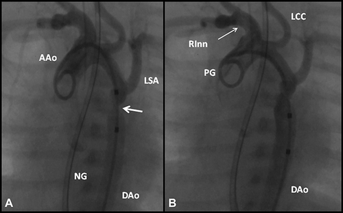 Figure 3 Selected cine frames from aortic cine angiograms in 20° left anterior oblique projection demonstrating narrowed coarcted aortic segment (arrow) before balloon angioplasty (A) which increased after balloon angioplasty (B). Moderate hypoplasia of distal transverse aortic arch and isthmus is also present. Modified from Rao PS. Role of interventional cardiology in neonates: Part II – Balloon angioplasty/valvuloplasty. Congenital Cardiol Today. 2008;6(1):1–14.Citation71