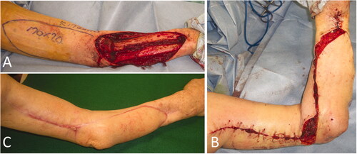 Figure 6. Intraoperative photographs of the patient in Case 3. (A) A 17 × 7 cm reverse lateral upper arm flap was designed. (B) The forearm and the elbow at the time of primary closure of the donor site. (C) Five months after flap implantation.