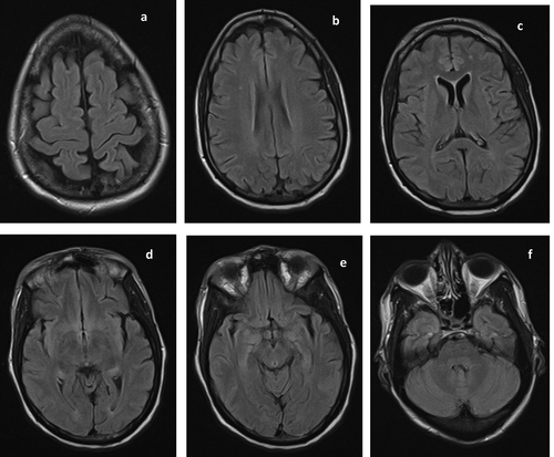 Figure 3. Repeat MRI done on hospital day 7 showed resolution of the previously noted extensive signal abnormalities. However, two punctate foci of FLAIR hyperintensities persisted in the right corona radiata (b) and left frontal lobe (c). These may represent age-related white matter changes or white matter hyperintensities of presumed vascular origin.