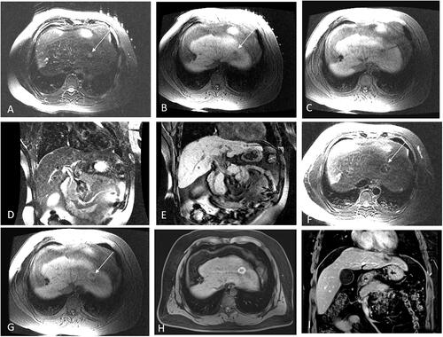 Figure 3. Recurrent HCC after liver resection in the hepatic dome abutting to heart of a 35-year-old man treated with MR-guided MWA. (A,B) The recurrent nodule 4.8 mm from pericardium,13 mm in diameter of segment II appears hyperintense in T2WI and hypointense in T1WI before MWA. (arrow in A,B). (C,D) The MW antenna is gradually targeted and inserted under the coronal T2WI, and the relationship between the antenna and heart is clearly displayed in coronal image. (E–G) A typical ‘target sign’ (arrow) is clearly shown in the ablative zone with the hypointense nodule completely overlapped by the hyperintensity on 3D-T1WI and hypointensity on T2WI, with a safe margin immediately after MWA and without diaphragm and heart injury. (H,I) The ablative zone with the ‘target sign’ is completely ablated without enhancement in MRI at 1-month follow-up.