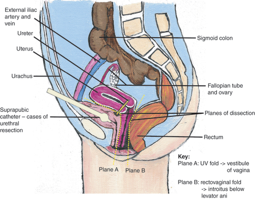 Figure 1. Sagittal view of dissection planes.