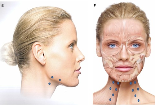 Figure 2 Injection sites to treat each lower facial indication, as recommended by the expert panel.