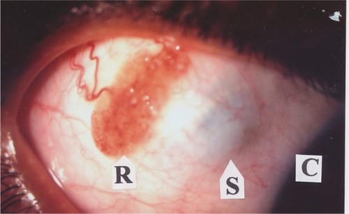Figure 1 The bulbar rhinosporidial growth (R), showing vascularity and granularity with whitish spots on the surface, and the gray-bluish spherical staphyloma (S) with ill-defined margins; cornea (C).