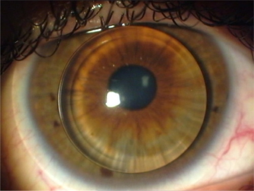 Figure 1 A view of optimal piggyback contact lens fitting. The rigid and soft lenses move independently and correctly at each blink as shown by biomicroscopic examination.