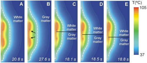 Figure 11. Temperature distributions at roll-off for different cases of neural tissue around the contacts (scale in °C) according to the model shown in Figure 4(A) (6 W applied power): white matter (a), gray matter (B), three different positions of the gray-white matter interface (indicated by a solid black line) (C − E). The coagulation boundary (white dashed line) is that of the 55 °C isotherm. The solid gray line indicates the electrode contour. The black arrows on panel B indicate the hot points at the ends of each contact when closest to each other.
