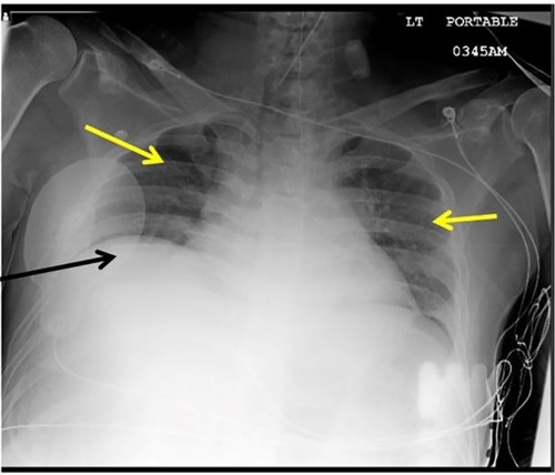Figure 1 Chest X-ray showing clear lung fields with low lung volumes (yellow arrows), elevated hemi diaphragm (black arrow).