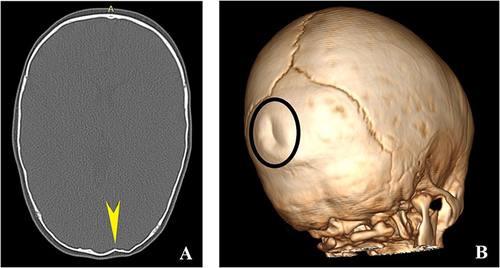 Figure 3 Axial NECT of an 11-month-old baby who was sitting on the wooden floor and fell on his back hitting the back of his head. Left occipital ping-pong fracture. (A) NECT axial section bone window shows an indent in the left occipital region, with no radiolucent line to suggest linear or comminutive fracture (yellow pointed arrow). (B) VRT image with the ping-pong fracture in the occipital region (black circle).