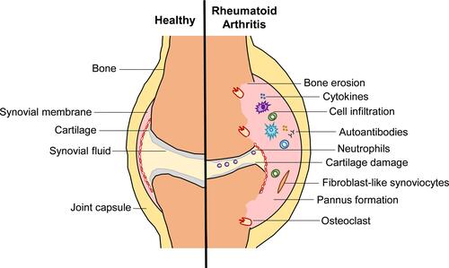 Figure 1 Pathological changes in a rheumatoid arthritis joint. In established RA, the inflamed synovial membrane forms a pannus, due to infiltration of peripheral blood cells and proliferation of fibroblast-like synoviocytes. These cells are highly activated releasing pro-inflammatory mediators and autoantibodies within the joint sustaining the inflammatory process. This is accompanied by cartilage damage and osteoclast-mediated bone erosion leading to invasion of the pannus tissue and irreversible deformation of the joint.