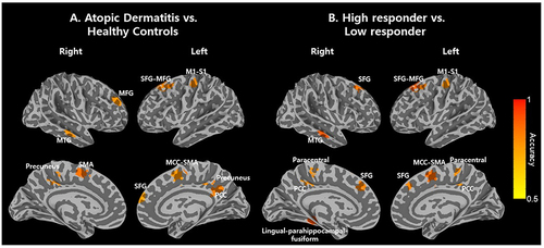 Figure 2 Neural biomarkers classification accuracies achieved by Long Short-Term Memory Models. We observed that patients with Atopic Dermatitis (AD) were accurately distinguished, and the outcomes of their acupuncture treatment were solely determined by the signals from resting-state functional magnetic resonance imaging (rs-fMRI) and long short-term memory models. (A) We identified distinct temporal features in the left supplementary motor area (SMA; mean accuracy 0.85, mean area under receiver operating characteristic curve [AUC] 0.85), right SMA (0.78, 0.78), right middle/posterior cingulate cortex (0.79–0.82, 0.79–0.81), left superior/middle/medial frontal gyri including the dorsolateral prefrontal cortex (0.71–0.81, 0.79–0.81), right superior/middle frontal gyrus (0.75–0.78, 0.75–0.79), left precentral gyrus (0.80, 0.80), right temporal pole (0.77, 0.77), left fusiform gyrus (0.74, 0.74), and right precuneus (0.71, 0.70) between patients with AD and healthy participants. These differences contributed to the classification of AD patients from healthy controls. (B) Using rs-fMRI signals obtained even before the acupuncture treatment, it was revealed that the right lingual-parahippocampal-fusiform gyrus (0.90, 0.89), right SMA (0.87, 0.87), left fusiform gyrus (0.90, 0.89), right superior middle frontal gyrus (0.84, 0.83), left superior/middle frontal gyrus (0.81–0.82, 0.80–0.84), left posterior cingulate cortex and precuneus (0.79, 0.68) have temporal characteristics that can distinguish high and low responders to acupuncture treatment in AD patients. The brain regions identified for diagnosing and predicting treatment responses may provide a basis for further research on the neural mechanisms of AD and the exploration of innovative treatment modalities in the future.