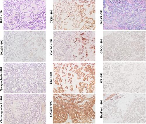 Figure 8 Example case of an ICC originated from the early CCP. A 72-year-old female patient with 4.0 cm sized tumor in the right lobe of the liver. The patient has chronic hepatitis B infection. The preoperative serum AFP and CA19-9 levels were 3.17 ng/mL and 25.63 ng/mL, respectively. Tumor recurrence was found at the end of the second month after right hemihepatectomy. Tumor cells are arranged in tubular, striped and antler-like structures with the positive expression of EpCAM, CK19, CK7, CA19-9 and NCAM (scattered). Hepatocytic lineage markers GPC3 and HepPar1, and neuroendocrine marks chromogranin and synaptophysin are not detected. Intracytoplasmic mucin was not found by D-PAS staining, indicating its ductule origin (non-mucin-producing ICC variant).