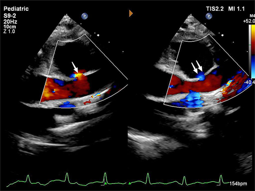 Figure 2 Doppler ultrasound image depicting bidirectional low-velocity blood flow signals entering and exiting the pseudoaneurysm at the rupture site. Single arrow: rupture site, red blood flow signals indicates blood flow into the pseudoaneurysm; Double arrows: rupture site, blue blood flow signals indicates blood flow out of the pseudoaneurysm.