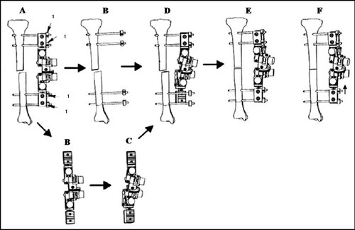 Figure 2. Workflow for using the Bone Reposition Device (BRD) as a template to guide the reduction process (1 = pin offset locator).