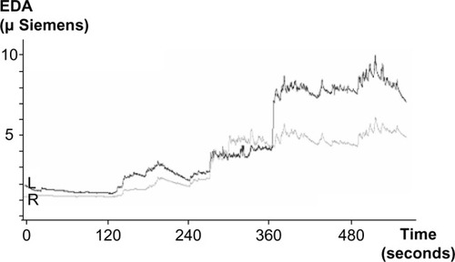 Figure 3 Electrodermal activity (EDA) values during periods of monopolar stimulation of the cerebellar structures. Time from 0 to 120 seconds represents resting state before the stimulation; EDA during the time from 120–240 and from 240–360 seconds reflects increasing stimulation from 1–1.5 V in the left (L) electrode contacts 1 and 3 of the anterior lobe–culmen; EDA during the time from 360 to 480 seconds and from 480 to the end reflects increasing stimulation from 1–1.5 V in the right (R) electrode contacts 1 and 3 of the central lobule–superior cerebellar peduncle.