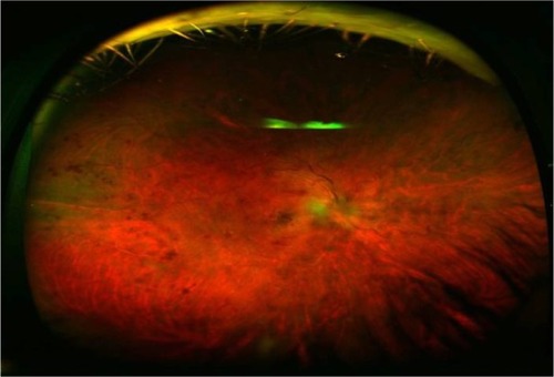 Figure 1 En face wide-field fundus photograph of the right eye of a patient with CRVO.