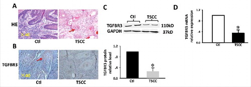 Figure 1. Expression of TGFBR3 in TSCC tissues. (A) H&E stain and IHC analysis. (B) TGFBR3 expression in matched normal human tongue tissue and TSCC specimens ( × 400 magnification). (C) Expression of TGFBR3 protein in specimens was evaluated by western blot analysis. (D) Expression of TGFBR3 mRNA in specimens was evaluated by RT-PCR. Glyceraldehyde 3-phosphate dehydrogenase (GAPDH) was used as loading control. These changes were quantitated using densitometry in (C). Data are expressed as the mean ± SEM from three independent experiments (n = 6). *p < 0.05 vs. control.