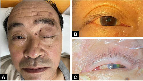 Figure 1 Clinical signs of the patient (A) Left blepharoptosis, crusted erythema on the left side of the face, upper eyelid, and nasal tip. (B) Right eye: normal pupil, PLR++ (C) Left eye: limited adduction dilated pupil, PLR+.