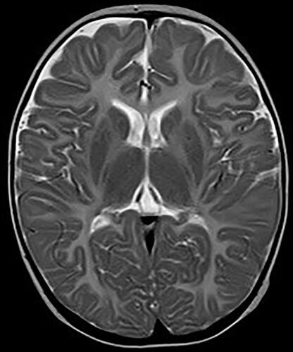 Figure 5 Axial MRI images at age of 9 months showing displayed diffusely and symmetrically abnormal signal in bilateral pallidus.