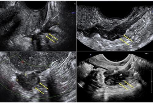 Figure 3 Ultrasound appearance of different nodules of deep infiltrating endometriosis of the bowel.