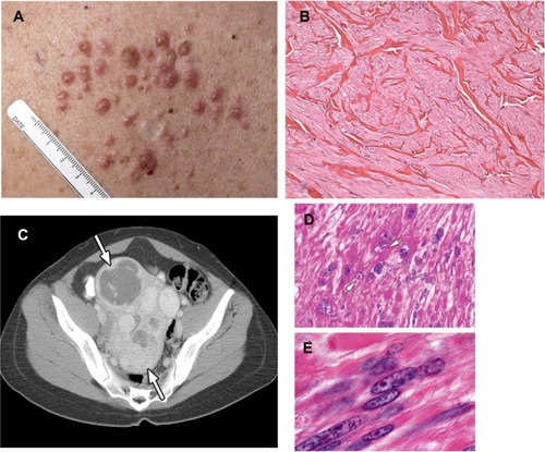 Figure 1 (A–E) Clinical manifestations of hereditary leiomyomatosis and renal cell carcinoma (HLRCC): leiomyomas.