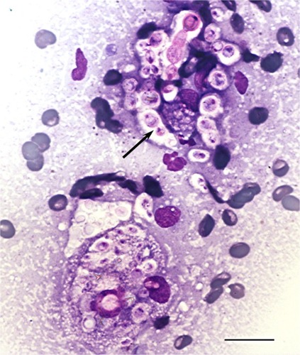 Figure 1 Fine-needle aspirate cytology of a cranial abdominal mass displaying numerous extracellular and intrahistiocytic Cryptococcus spp. yeasts with prominent nonstaining capsules, narrow-based budding (arrow), and occasional chains of organisms.