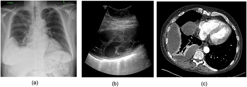 Figure 1. Chest radiograph (CXR), ultrasound and CT scan from a patietn with empyema, ullustrating the difference in information gleaned from each. A) CXR showing unilateral pleural effusion. B) Ultrasound demonstrating septated, organised pleural space and C) CT showing loculations and visceral pleural enhancement.