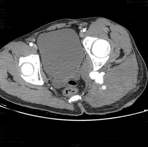 Figure 2 Axial CT scan showing voluminous hematoma infiltrating the gluteal muscles.
