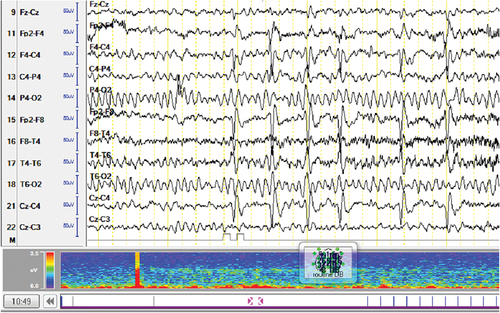 Figure 4. The EEG test for the epileptic patient in Erbil teaching hospital.