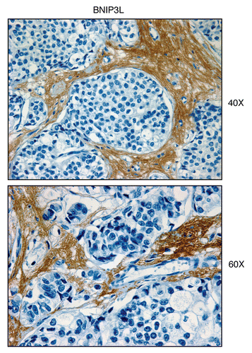 Figure 3 BNIP3L, a mitophagy marker, is elevated in the stroma of human breast cancers. Paraffin-embedded sections of human breast cancer samples lacking stromal Cav-1 were immuno-stained with antibodies directed against BNIP3L. Slides were then counter-stained with hematoxylin. Note that BNIP3L is highly expressed in the stromal compartment of human breast cancers that lack stromal Cav-1. Two representative images are shown. Original magnification, 40x and 60x, as indicated.