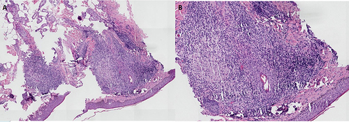 Figure 2 Histopathological examination of granulomatous rosacea. (A and B) The epidermis appears largely normal, and a large number of granulomas composed of epithelial cells, lymphocytes, and multinucleated giant cells can be observed around the hair follicles in the dermis, with no signs of caseous necrosis.