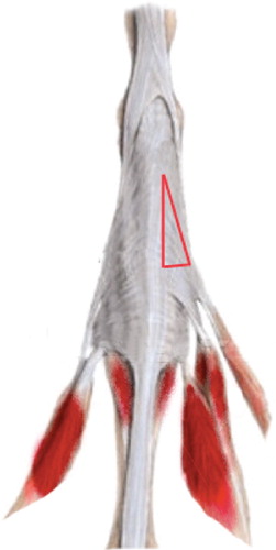 Figure 2. The extensor apparatus of a finger. The red triangle shows the area that should be resected in the distal ulnar intrinsic release procedure. The triangular piece consists of oblique fibres and the ulnar lateral band.