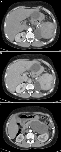 Figure 3 Arterial (A, C) and portal (B) phase axial images showed a well-opacified tortuous splenic artery at the splenic hilum (black arrowhead in A). The proximal portion was also well opacified, with no evidence of a filling defect. The portal phase showed multiple non-enhanced tubular structures (white arrowhead in B) in the expected location of the splenic vein, signifying chronic splenic vein thrombosis. More inferiorly, inflammatory stranding was seen in the left perinephric space, with prominent left anterior renal and lateroconal fasciae (white arrow in C). Along the left peritoneal surface, a smaller but similar cystic lesion was visible (black arrowhead in C). Multiple non-enhancing splenic cysts were evident.