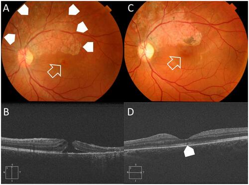 Figure 3 Case # 8. (A) Color photo of the left eye of a 16-year-old male patient. The patient sustained blunt trauma to the left eye by a stick approximately 2 months earlier. His BCVA was 0.25 decimal. The posterior pole showed a small FTMH (white arrow). Note, the area of diffuse RPE mottling in the superior vicinity of the hole denoting the chronic course (white arrow-heads). (B) High-definition 5-line raster OCT image of the same eye showed FTMH with MLD 225µ. Note the cystic thickening at the edges of the hole. (C) Color photo of the same eye 9 months after PPV and modified IFT, showed successful hole closure (white arrow). His final BCVA was unchanged. (D) High-definition 5-line raster OCT image post-operatively showed U-type closure. The ELM and IS/OS showed sub-foveal dehiscence (white arrow-head).