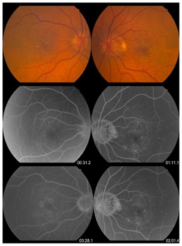 Figure 2 Fundus color photographs and early and late phases of fluorescein angiography.