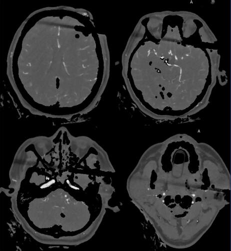 Figure 6 Computed tomography angiography shows no visible intracranial vascular injury.