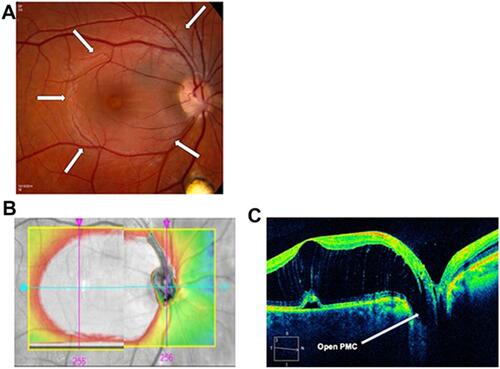 Figure 1 (A) At presentation. Fundus photograph of optic disc, maculoschisis (outlined with white arrows), and inferior coloboma. There is slight depigmentation within the small subfoveal detachment, but no abnormality of the macular retinal pigment epithelium (RPE) elsewhere, since schisis fluid is not in contact with the RPE. (B) Composite OCT topography image of a “giant” maculoschisis cavity, in direct contact with the ODP. (C) OCT cross-section image showing a wide-open pit-macula communication (PMC) (12/15/14, CMT 906 microns, Volume 20.8 mm3).Abbreviations: OCT, optical coherence tomography; ODP, optic disc pit; CMT, central macular thickness.