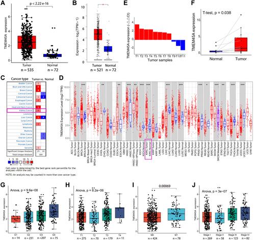 Figure 1 Higher expression of TMEM45A in ccRCC tissues than in normal renal tissues. (A) Data of the 535 tumour samples and 72 normal renal samples from TCGA-KIRC cohort. (B) Data from the GEPIA2 (http://gepia2.cancer-pku.cn/) database. (C) Data from the Oncomine (https://www.oncomine.org/) database. (D) TMEM45A expression in the pan-cancer analysis from the TIMER (https://cistrome.shinyapps.io/timer/) database. (E) Upregulation of TMEM45A in eight of the eleven ccRCC samples compared with that in the paired normal renal samples. (F) Significant increase in TMEM45A expression in the tumour samples compared with that in the paired normal renal samples. (G–J) Significantly increased TMEM45A expression with higher histological grade and T stage, distant metastasis and advanced TNM stages. *p < 0.05, **p < 0.01, ***p < 0.001.