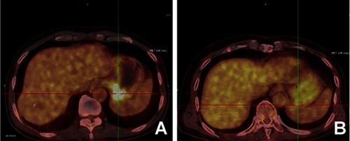 Figure 2 PET data: (A) PET on 2018/3/21: Abnormal increase of FDG metabolism in the irregular thickening of the gastric wall on the small curvature side of the stomach bottom malignant; (B) PET on 2018/8/14: The metabolism of FDG in gastric fundus was slightly elevated, and no specific active tumors were found.