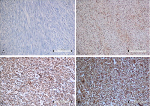 Figure 1. EBP50 staining images in uterine smooth muscle tumour types of some patients. A. Leiomyoma showed no immunoreactivity with EBP50 (immunoperoxidase, 200×). B. Mitotically active leiomyoma showed weak immunoreactivity with EBP50 (immunoperoxidase, 200×). C. STUMP showed moderate immunoreactivity with EBP50 (immunoperoxidase, 200×). D. LMS showed strong immunoreactivity with EBP50 (immunoperoxidase, 200×). Scale bar = 500 µm.