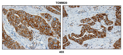 Figure 1 Metastatic breast cancer cells have increased mitochondrial mass. Paraffin-embedded sections of human breast cancer-positive lymph nodes were immunostained with antibodies directed against TOMM20 (brown color). Slides were then counterstained with hematoxylin (blue color). Note that TOMM20 is highly expressed in metastatic breast cancer cells. Two representative images are shown. Original magnification, 40x.