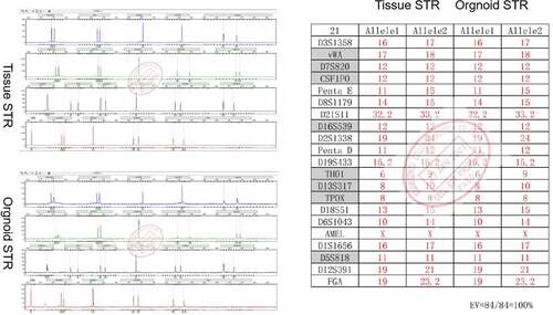 Figure 3. Short Tandem Repeat (STR) profiles of the adenomyoepithelioma (AME) organoids and the original AME tissue. The STR profiles revealed a 100% match between the two