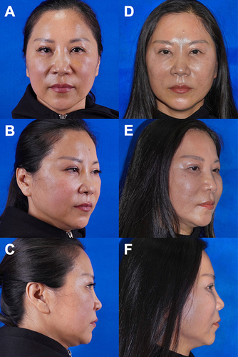 Figure 14 Preoperative (A–C) and 6 months postoperative (D–F) photographs of a 52-year-old female patient with remarkable improvement in the midcheek grooves and nasolabial folds.