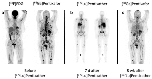 Figure 1. An illustrative example of Pentixather RLT in a MM patient. (a) Baseline dual tracer [18F]FDG/[68Ga]Ga-Pentixafor PET/CT showed multiple lesions, strongly CXCR4-positive. (b) [177Lu]Lu-Pentixather planar images demonstrated tracer incorporation within skeletal lesions. (c) Follow-up [68Ga]Ga-Pentixafor PET/CT depicted partial response to the RLT. Reprinted from Lapa et al. [Citation16], under a Creative Commons Attribution 4.0 International License (http://creativecommons.Org/licenses/by/4.0/). No changes were made.