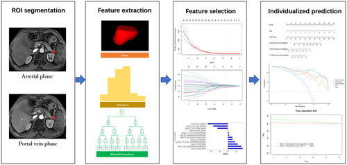 Figure 1. Workflow of the development of the radiomic nomogram.