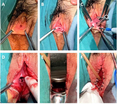 Figure 1. Procedure for labial fusion dissection. (a, b) Overview of the fused labial minora. Only the urethra meatus was visible. (c) A metal urethral catheter was inserted as a guide to avoid urethral injuries. (d) The fused labial minora were separated, and the vagina was revealed to have a normal width. (e) A normal cervix was evident. (f) The edges of the incision were sutured with 1/0 coated VICRYL separately